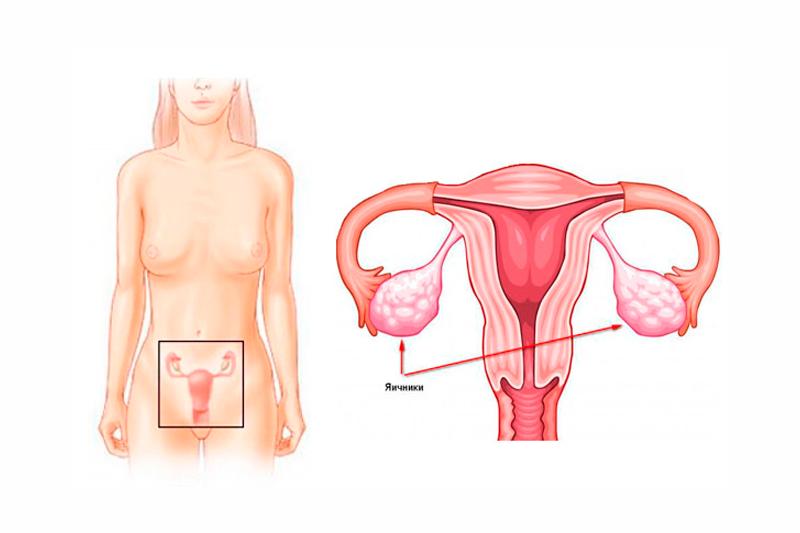 Синдром резистентных яичников