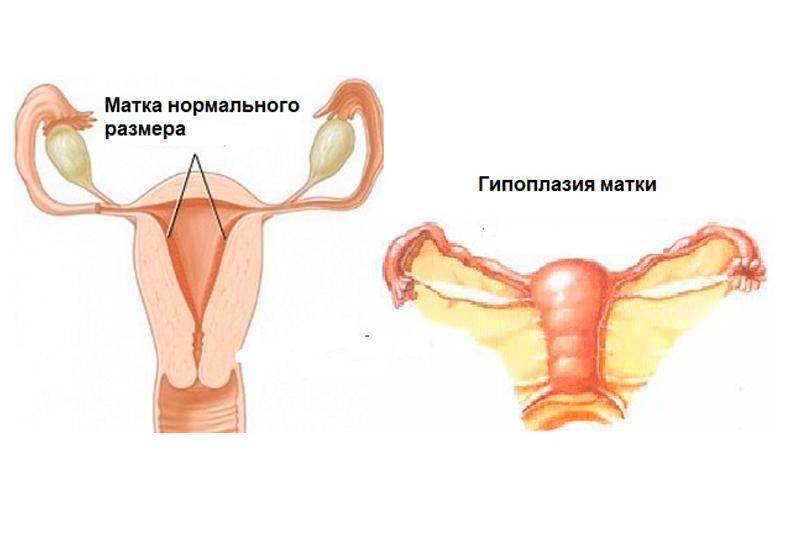 Гипоплазия матки