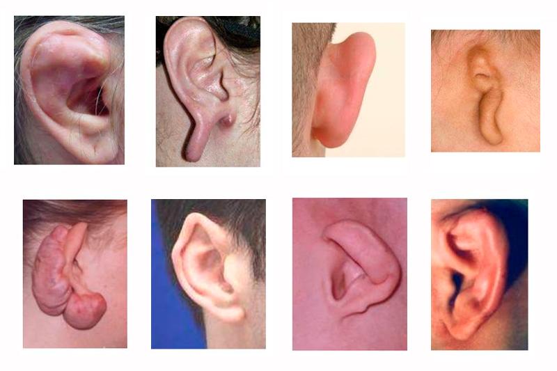 Деформация ушной раковины