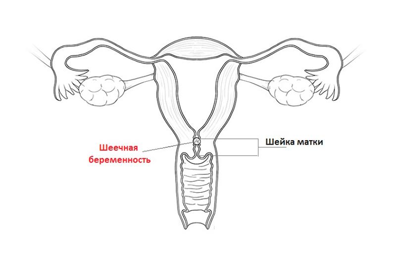 Шеечная беременность