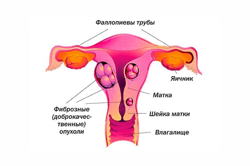 Фиброма матки