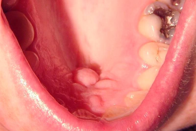 Доброкачественные опухоли полости рта