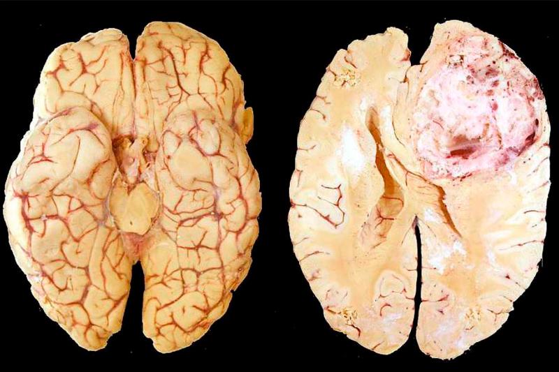 Внутримозговые опухоли полушарий мозга