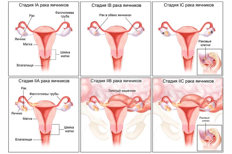 Рак яичников