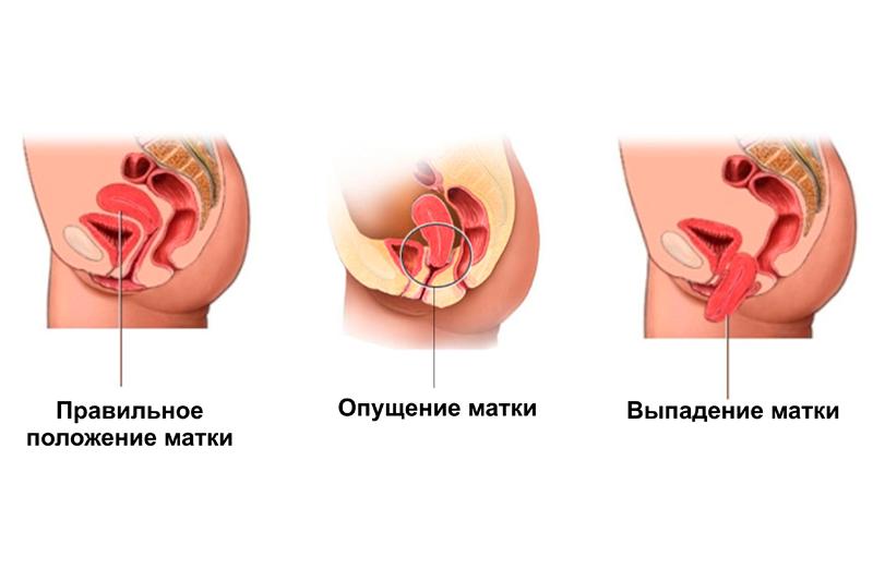 Выпадение матки и влагалища