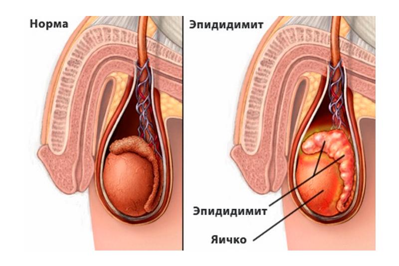 эпидидимит при урогенитальном уреаплазмозе у мужчин