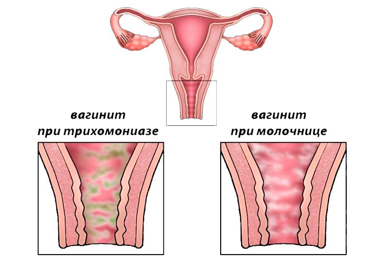 Вагинит Вагинит