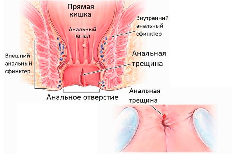 Анальная трещина Анальная трещина