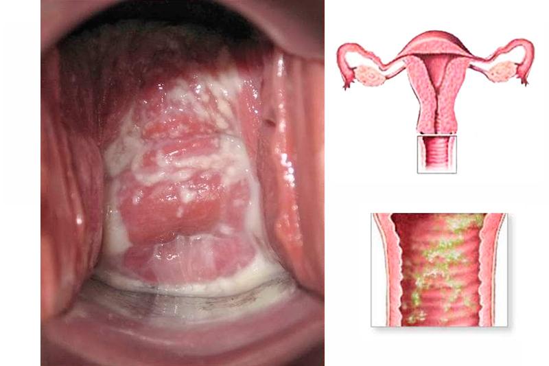 Симптомы кольпита у беременных