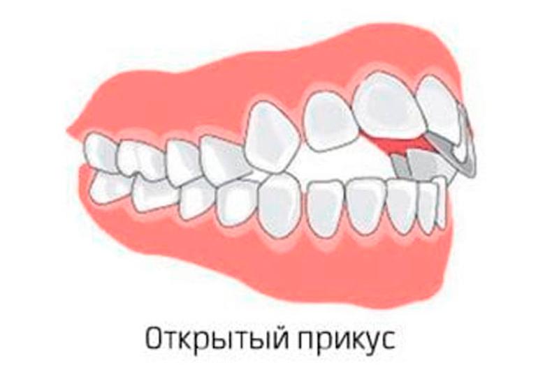 Открытый прикус Открытый прикус