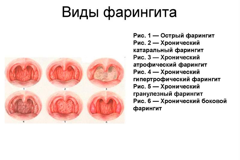 Фарингит Фарингит