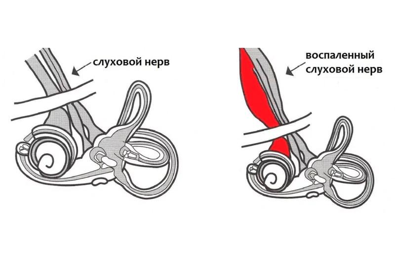 Кохлеарный неврит