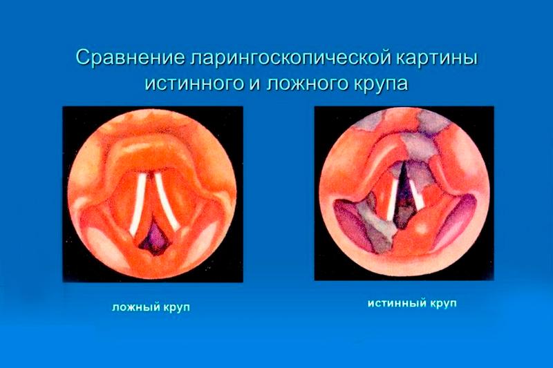 Ложный круп Ложный круп