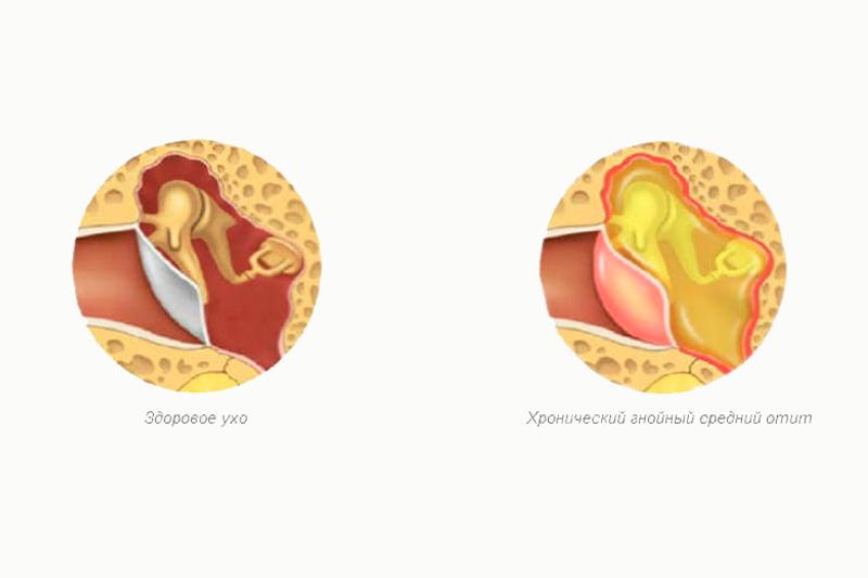 Острый и хронический гнойный средний отит это thumbnail