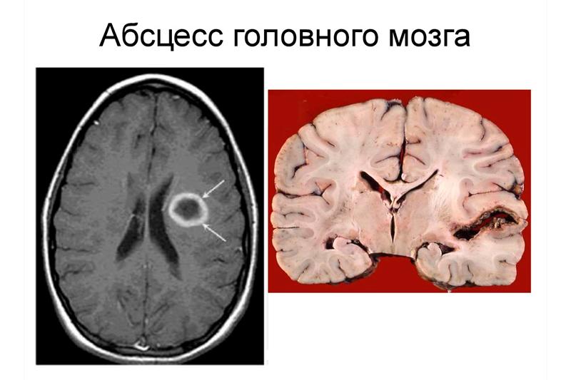 Абсцесс головного мозга