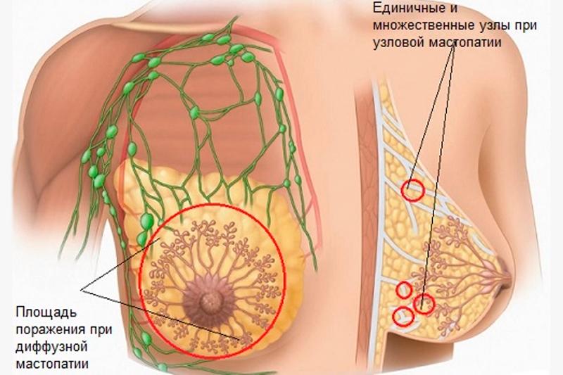 Диффузная мастопатия
