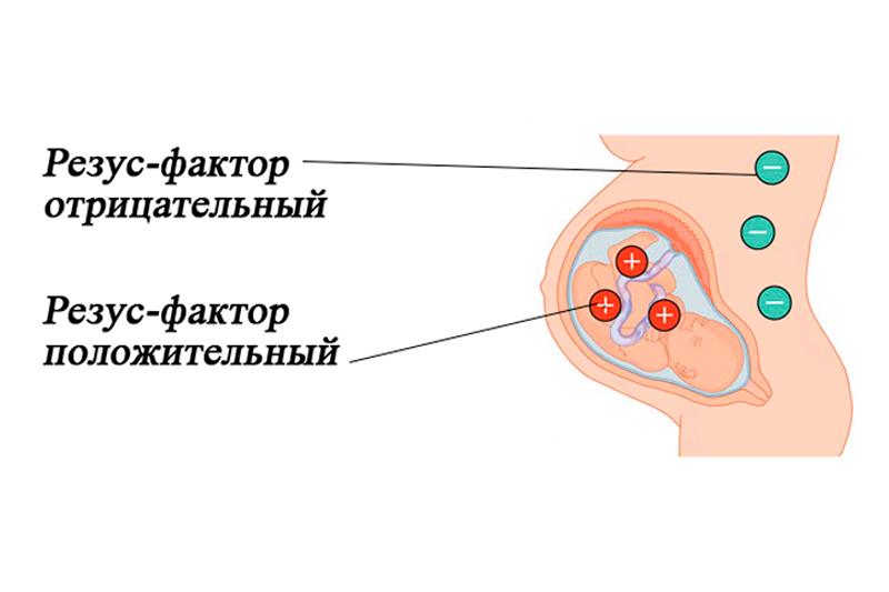 Гемолитическая болезнь плода