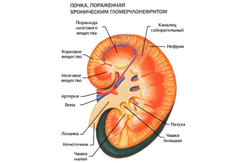 Хронический гломерулонефрит