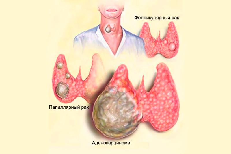 Новообразования щитовидной железы