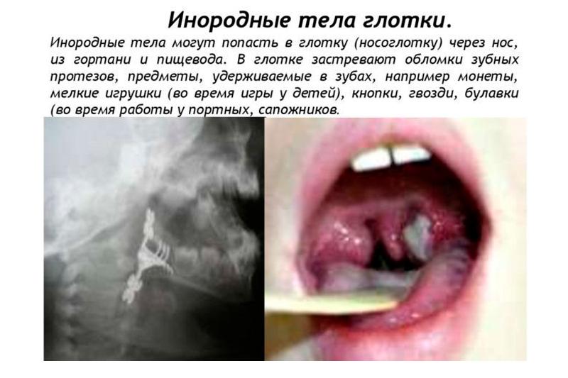 Инородные тела глотки Инородные тела глотки
