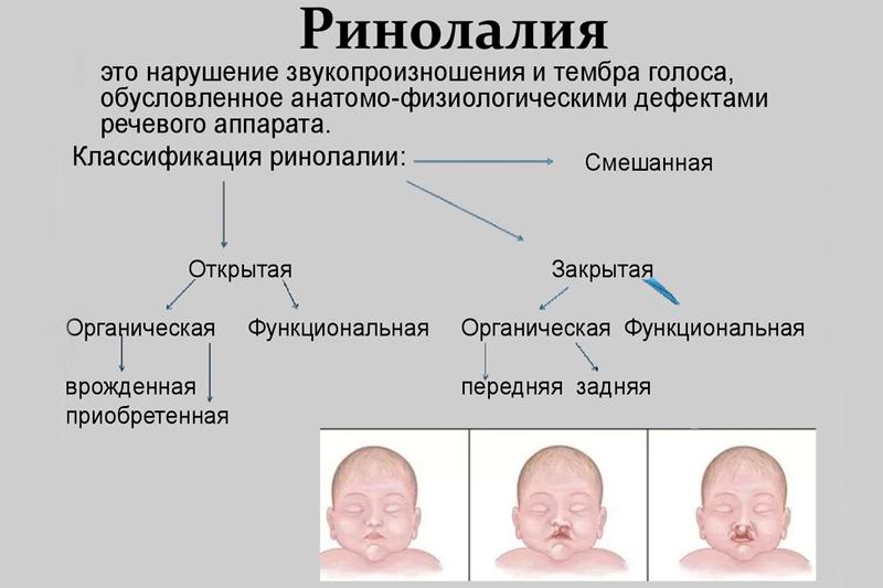 Виды расщелин при ринолалии рисунок