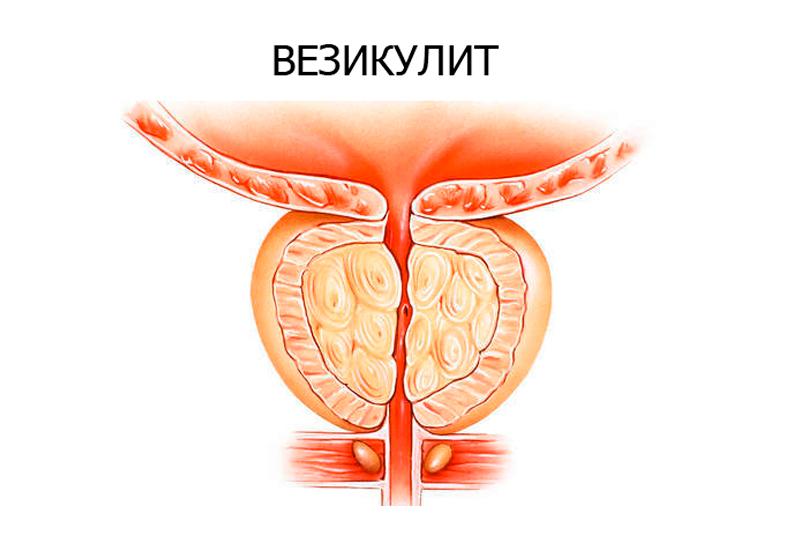 Везикулит