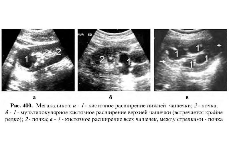 Мегакаликоз