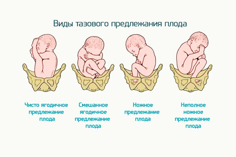 Тазовое предлежание плода