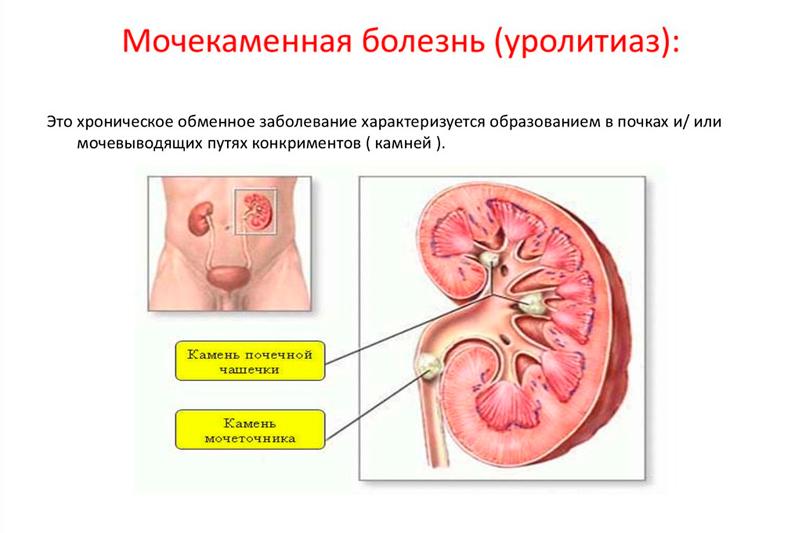 Мочекаменная болезнь