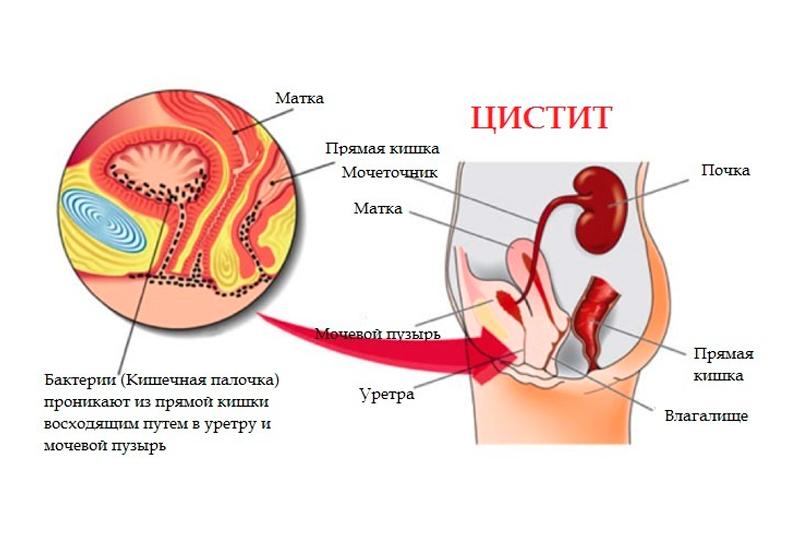 Цистит у женщин