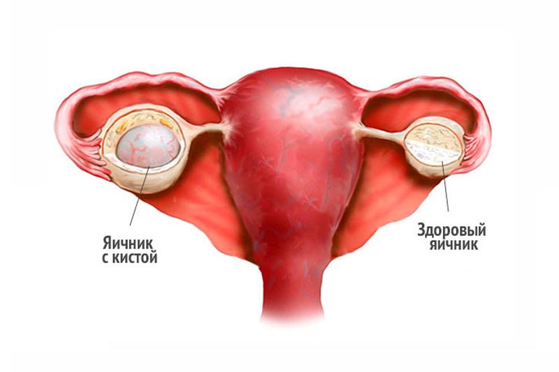 Киста яичника