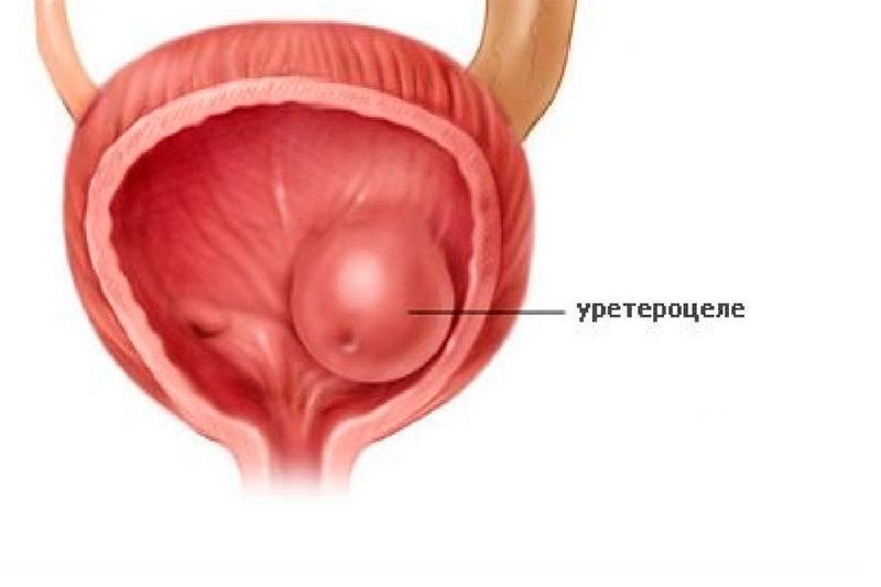 Уретероцеле Уретероцеле