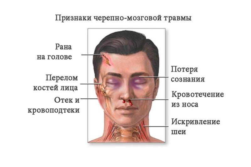 Черепно-мозговая травма Черепно-мозговая травма