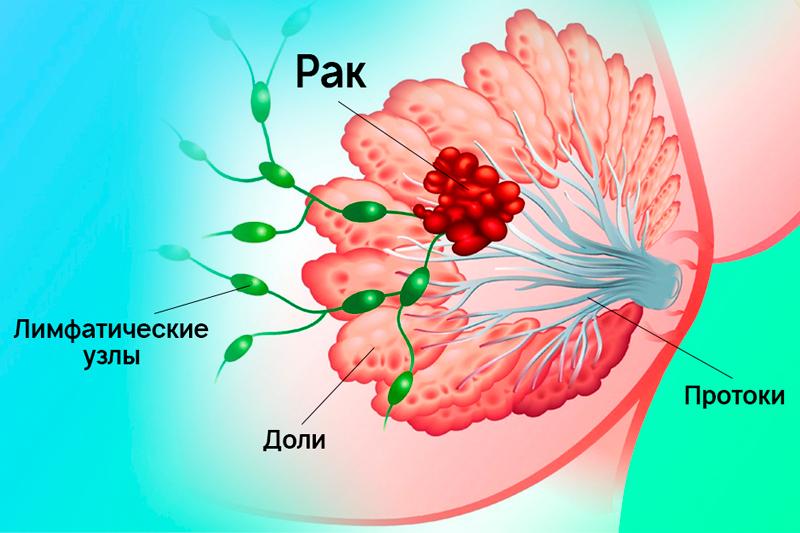 Рак молочной железы Рак молочной железы