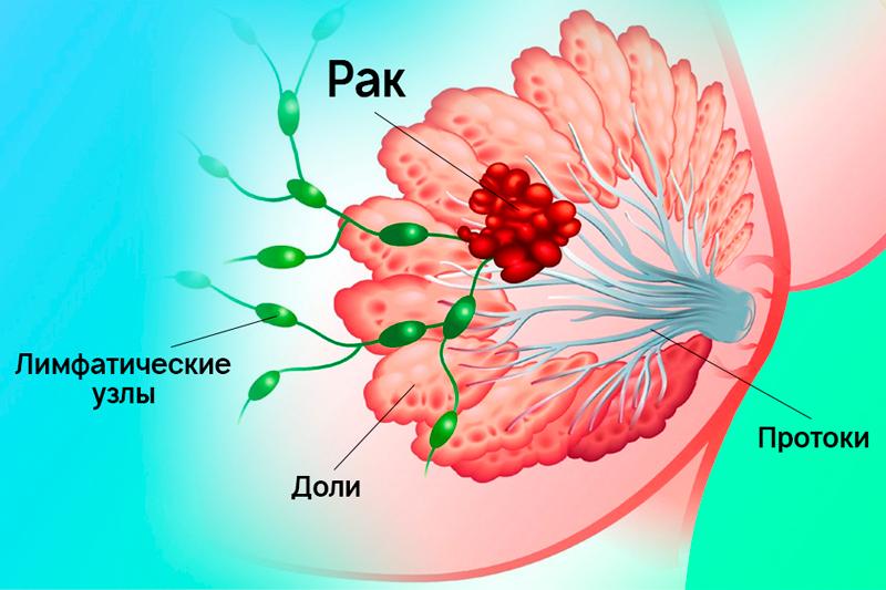 Рак молочной железы