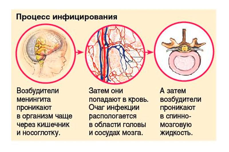 Менингит