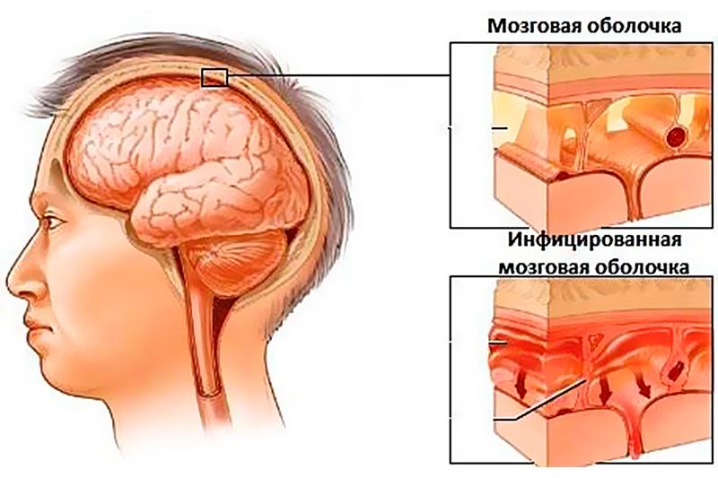 Гнойный менингит