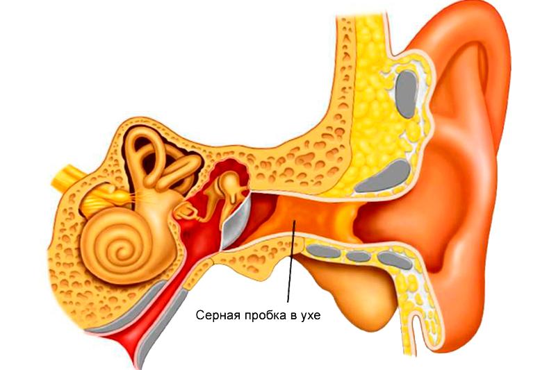 Серная пробка в ушах