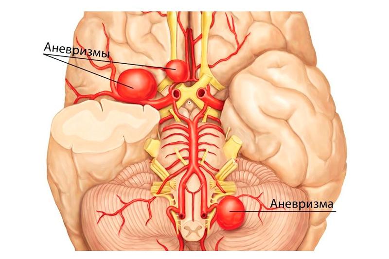 Аневризмы сосудов головного мозга