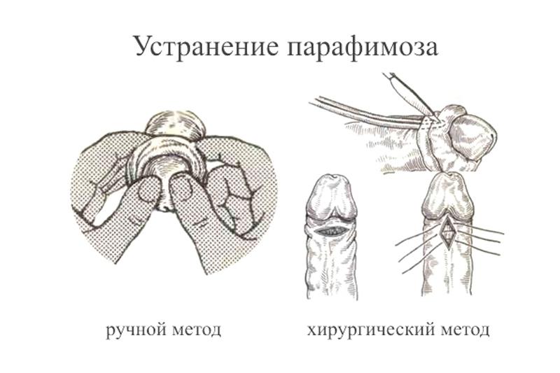 Парафимоз Парафимоз