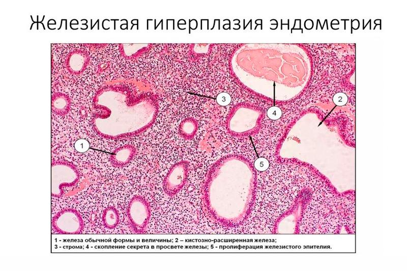 Нерегулярные менструации