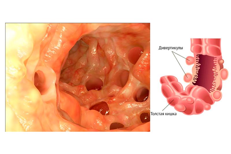 Дивертикулярная болезнь толстого кишечника