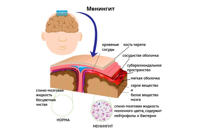 Вирусный менингит