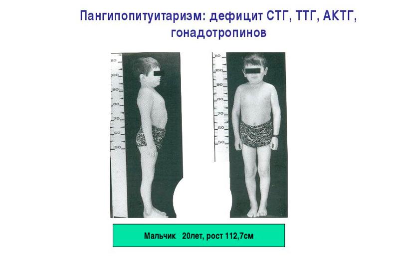 Синдром шиена презентация