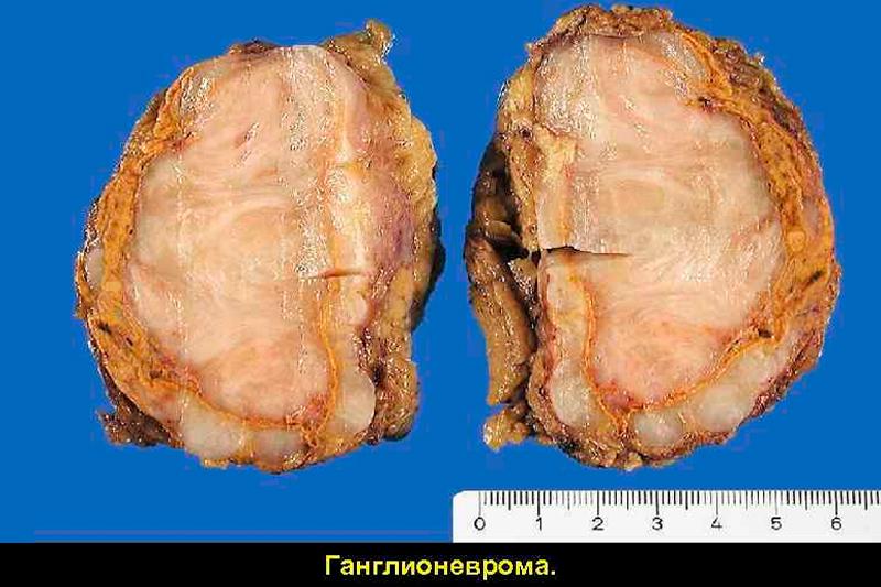 Ганглионеврома Ганглионеврома