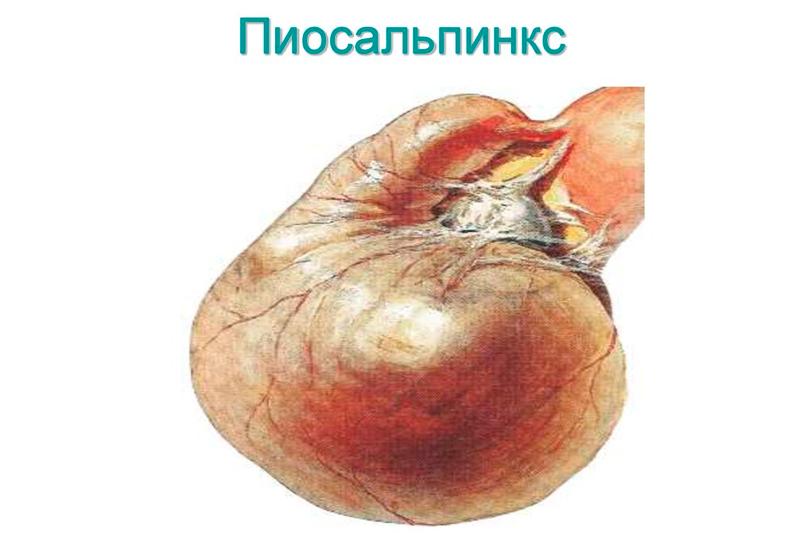 Пиосальпинкс