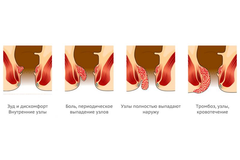 Геморрой клиника этиология лечение thumbnail