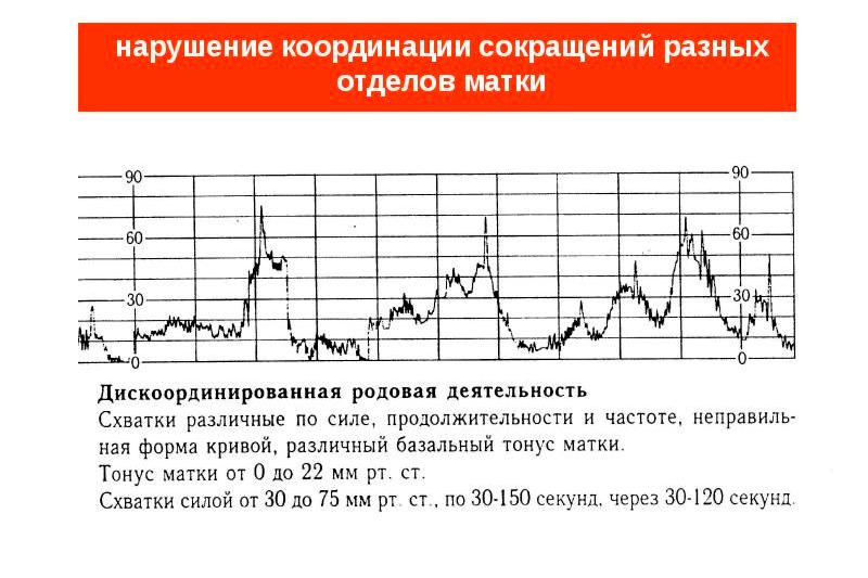Дискоординированная родовая деятельность Дискоординированная родовая деятельность