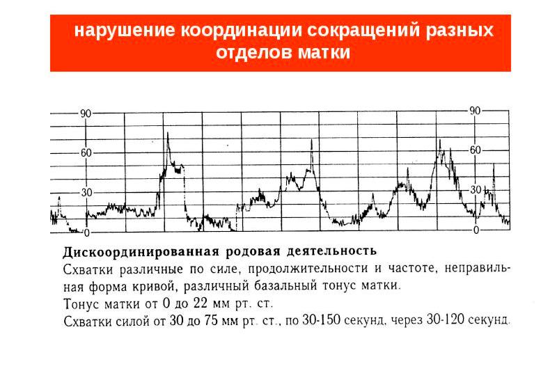 Дискоординированная родовая деятельность