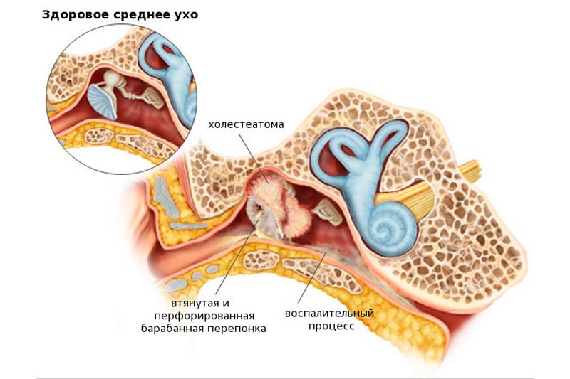 Холестеатома уха